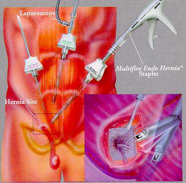 chirurgie-coelioscopique.jpg