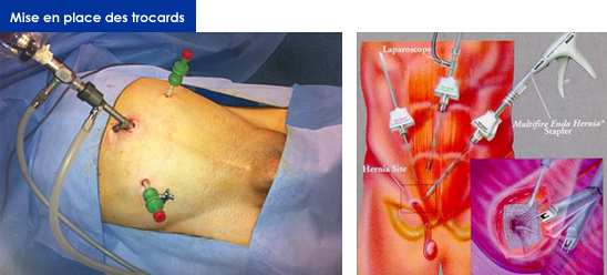 chirurgie-coelioscopie-hernie-inguinale