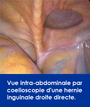 vue-coloescopie-hernie-inguinale-droite-directe