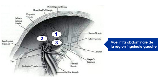 vue-intra-abdominal-region-inguinale-gauche